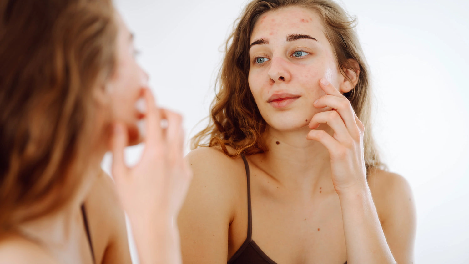 How Blackheads and Whiteheads Form: A Simple Scientific Breakdown