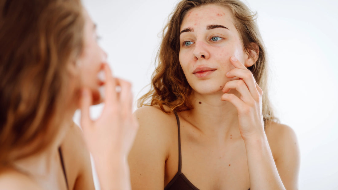 How Blackheads and Whiteheads Form: A Simple Scientific Breakdown