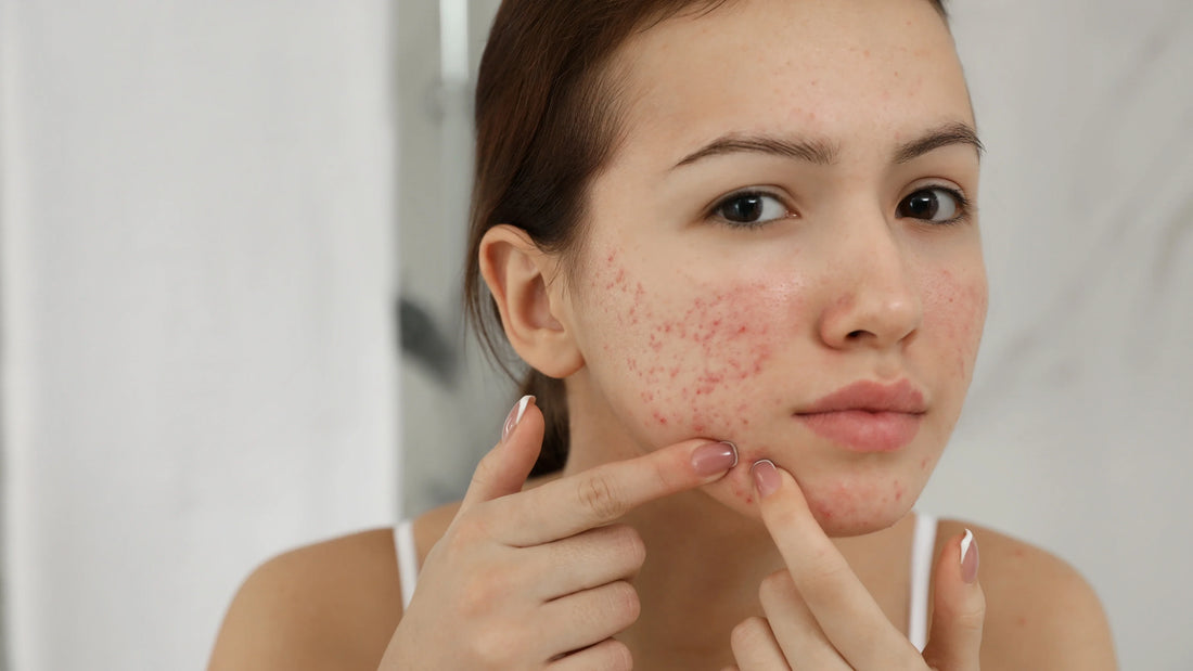 Botanical Anti-Acne Power in NURSAN Porederm Toner